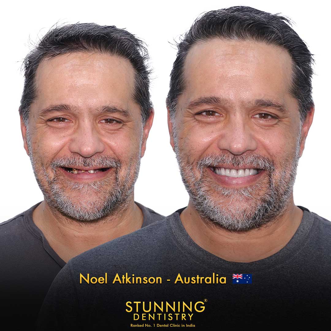 Before and after case 1