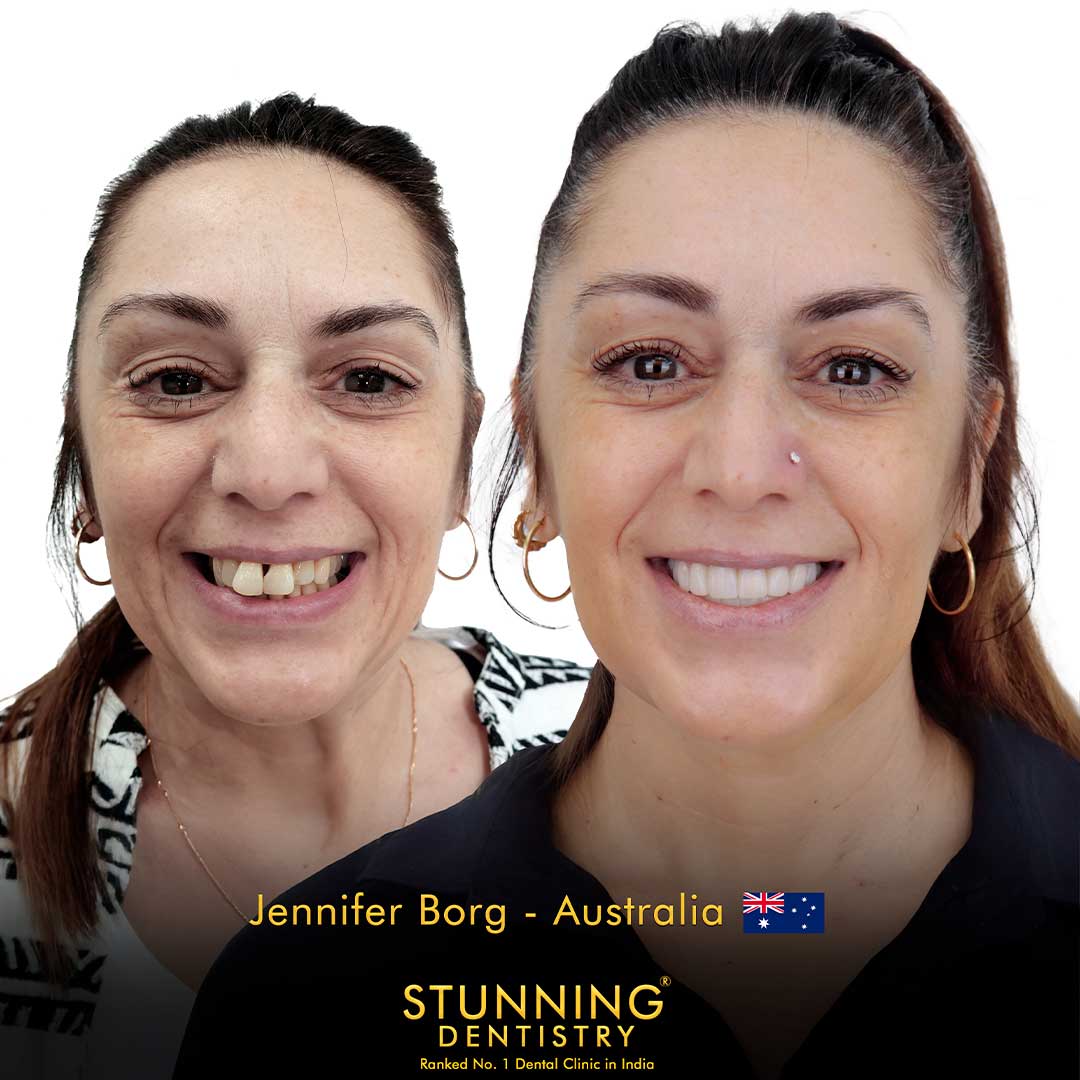 Before and after case 5