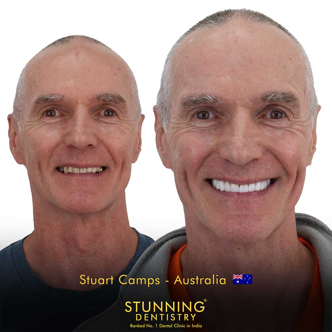 Before and after case 6