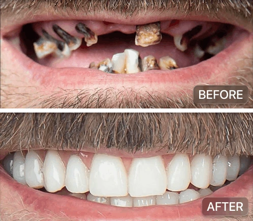 Full mouth reconstruction pre and post op