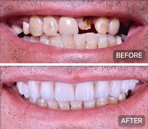 Full mouth implants pre and post op