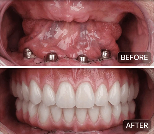 All on 4 implants pre and post op